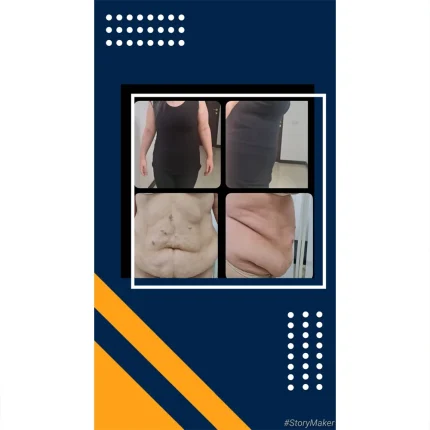 جراحی زیبایی ابدومینوپلاستی