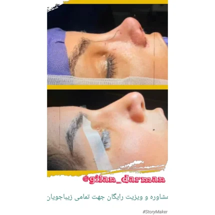 جراحی زیبایی بینی یا رینوپلاستی